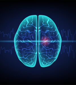 brainwaves after a stroke